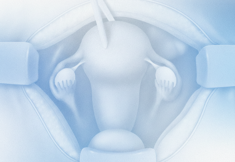 Abdominal (Açık) Histerektomi