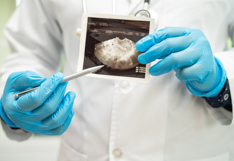 Vajinal Histerektomi